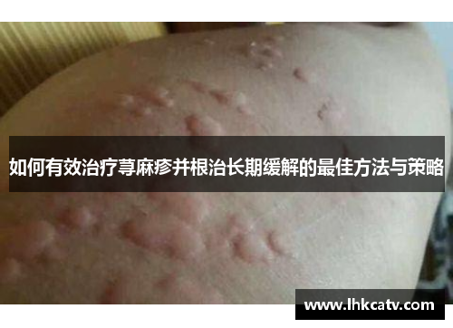 如何有效治疗荨麻疹并根治长期缓解的最佳方法与策略